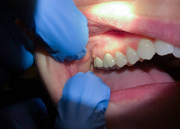 Best Urgent Care for Lost Fillings or Crowns in Macon, GA
